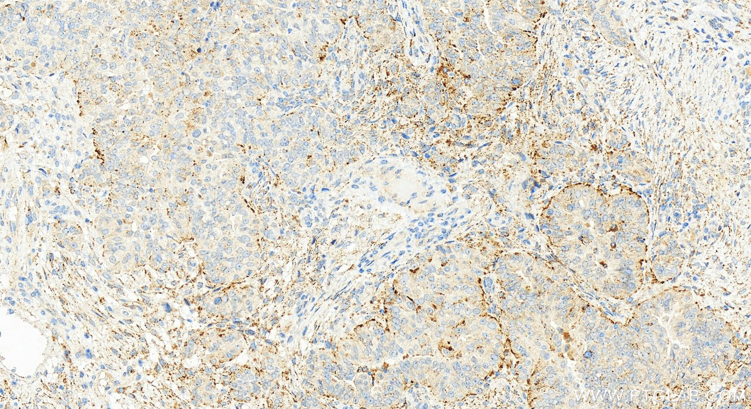 Immunohistochemistry (IHC) staining of human ovarian  cancer using TLR3 Recombinant antibody (83136-3-RR)