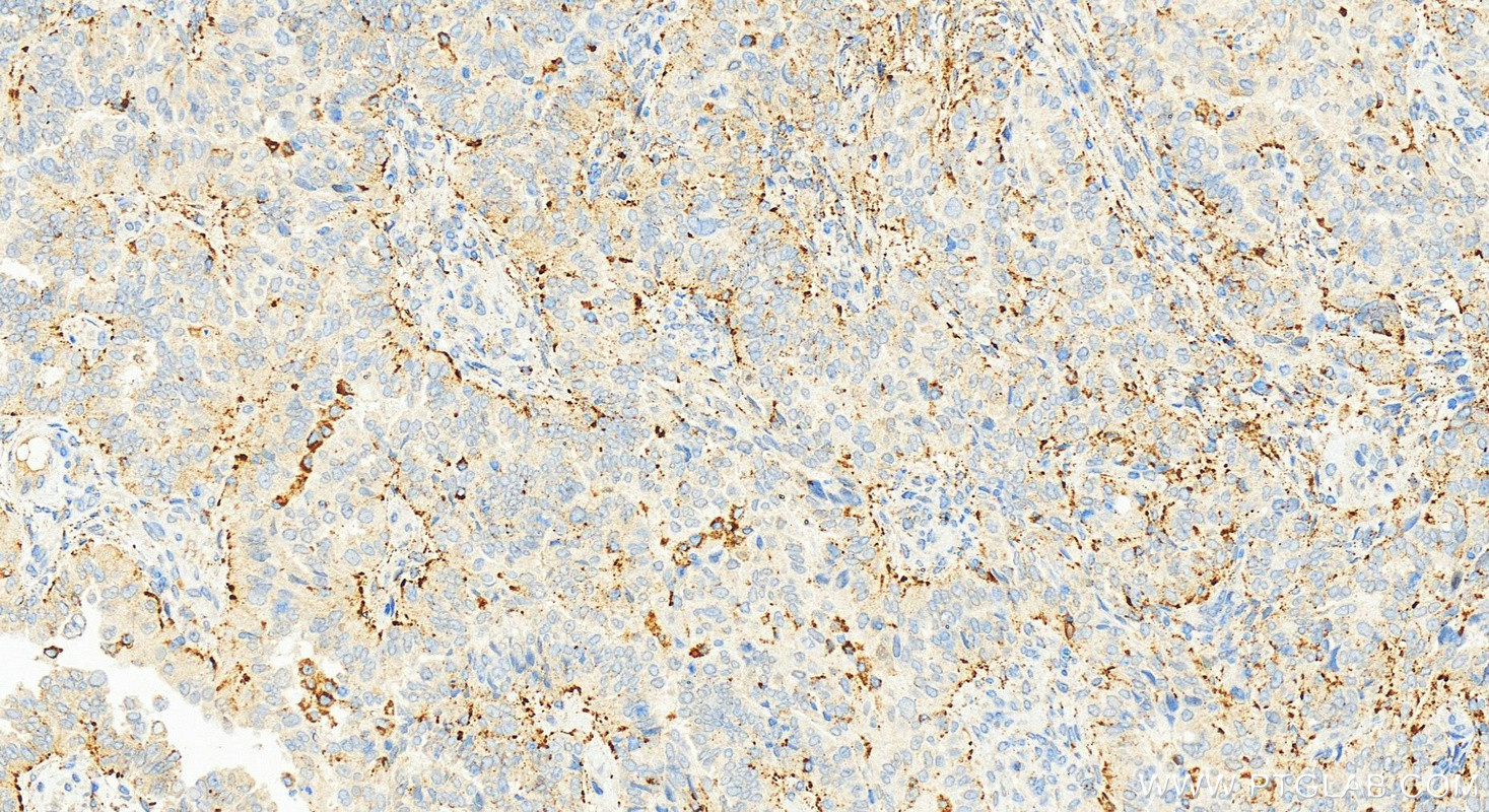 Immunohistochemistry (IHC) staining of human ovarian  cancer using TLR3 Recombinant antibody (83136-3-RR)