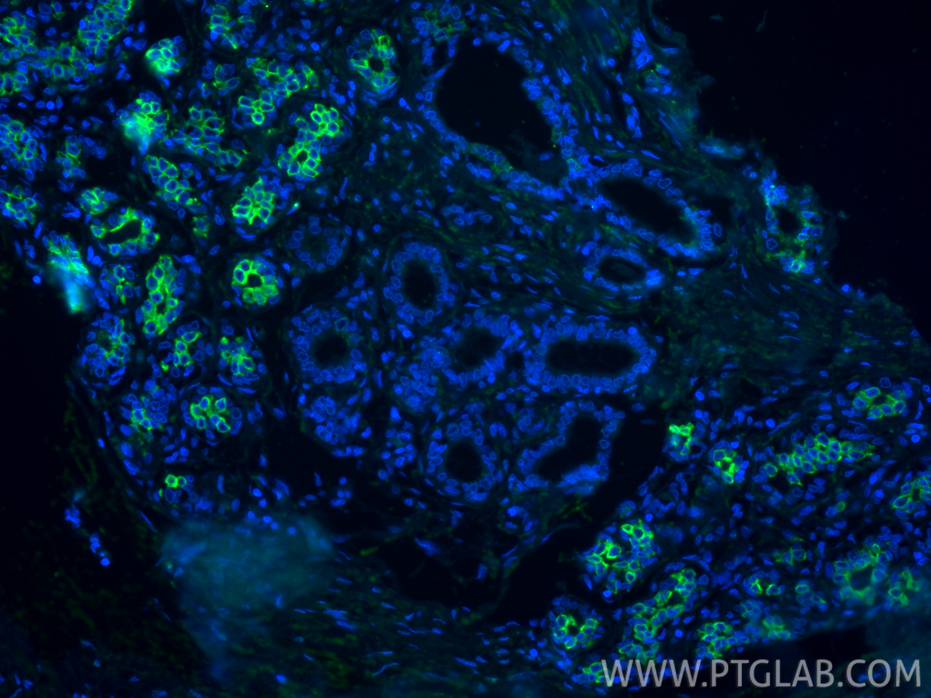 Immunofluorescence (IF) / fluorescent staining of human breast cancer tissue using FITC Plus-conjugated TLR8 Monoclonal antibody (FITC-67317)