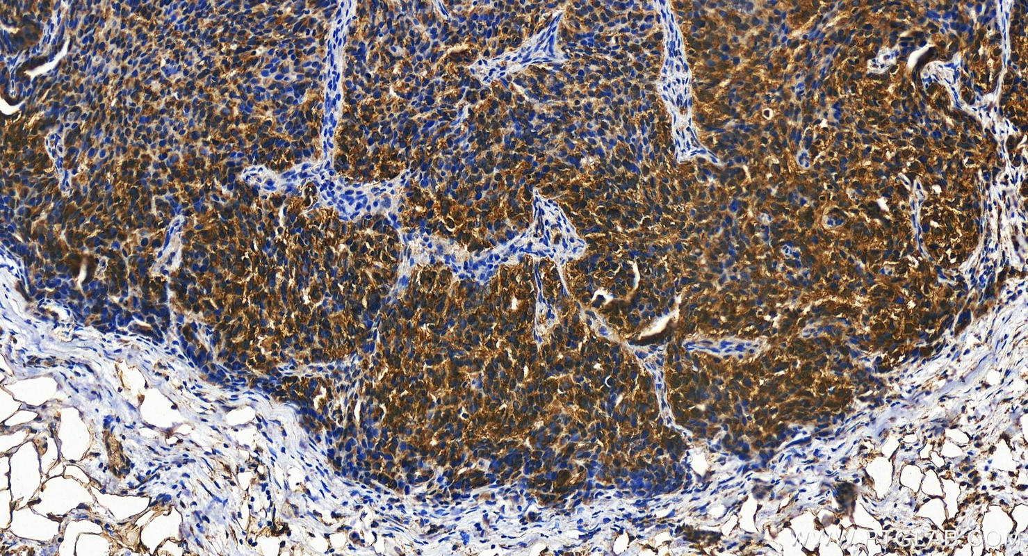 Immunohistochemistry (IHC) staining of human ovary cancer tissue using TM7SF3 Polyclonal antibody (19826-1-AP)