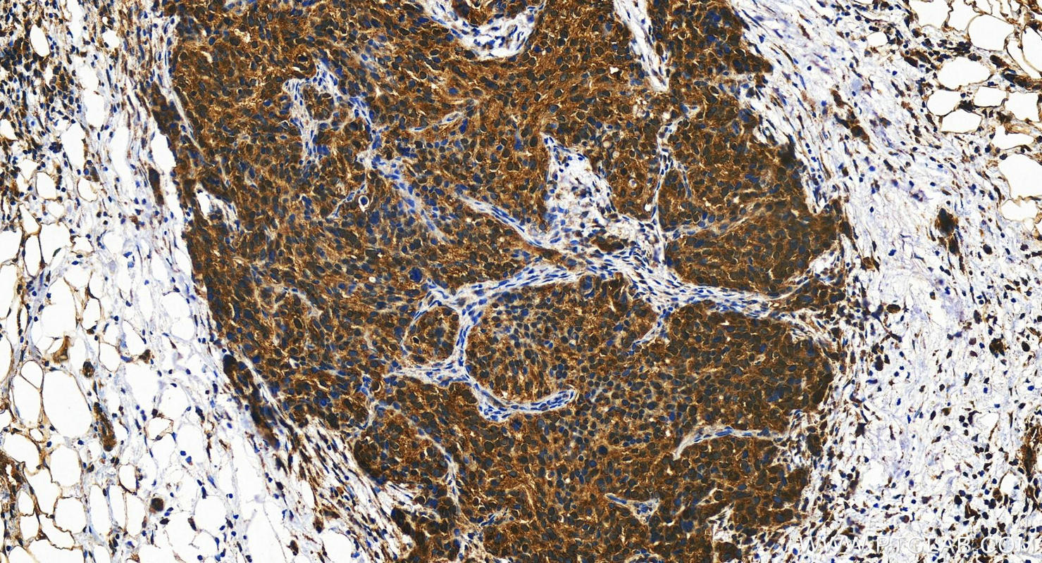 Immunohistochemistry (IHC) staining of human ovary cancer tissue using TM7SF3 Polyclonal antibody (19826-1-AP)