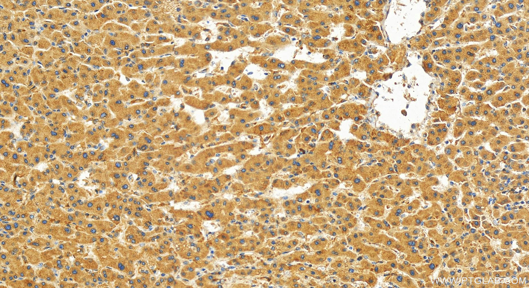 Immunohistochemistry (IHC) staining of human intrahepatic cholangiocarcinoma tissue using TMCO1 Polyclonal antibody (27757-1-AP)