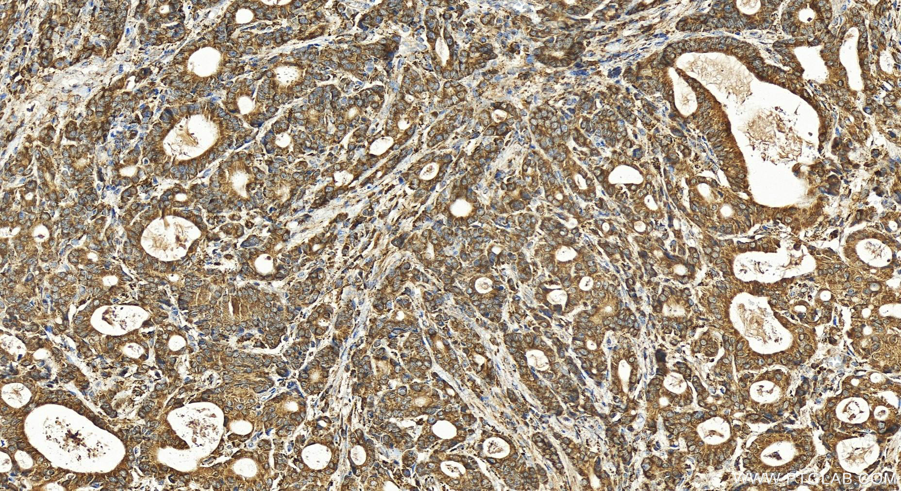 Immunohistochemistry (IHC) staining of human stomach cancer tissue using TMED3 Polyclonal antibody (21902-1-AP)