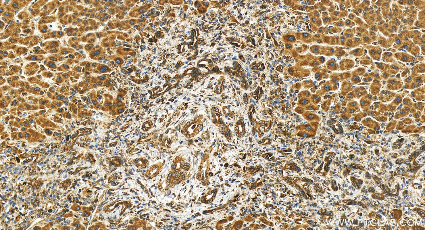 Immunohistochemistry (IHC) staining of human intrahepatic cholangiocarcinoma tissue using TMEM111 Polyclonal antibody (24645-1-AP)