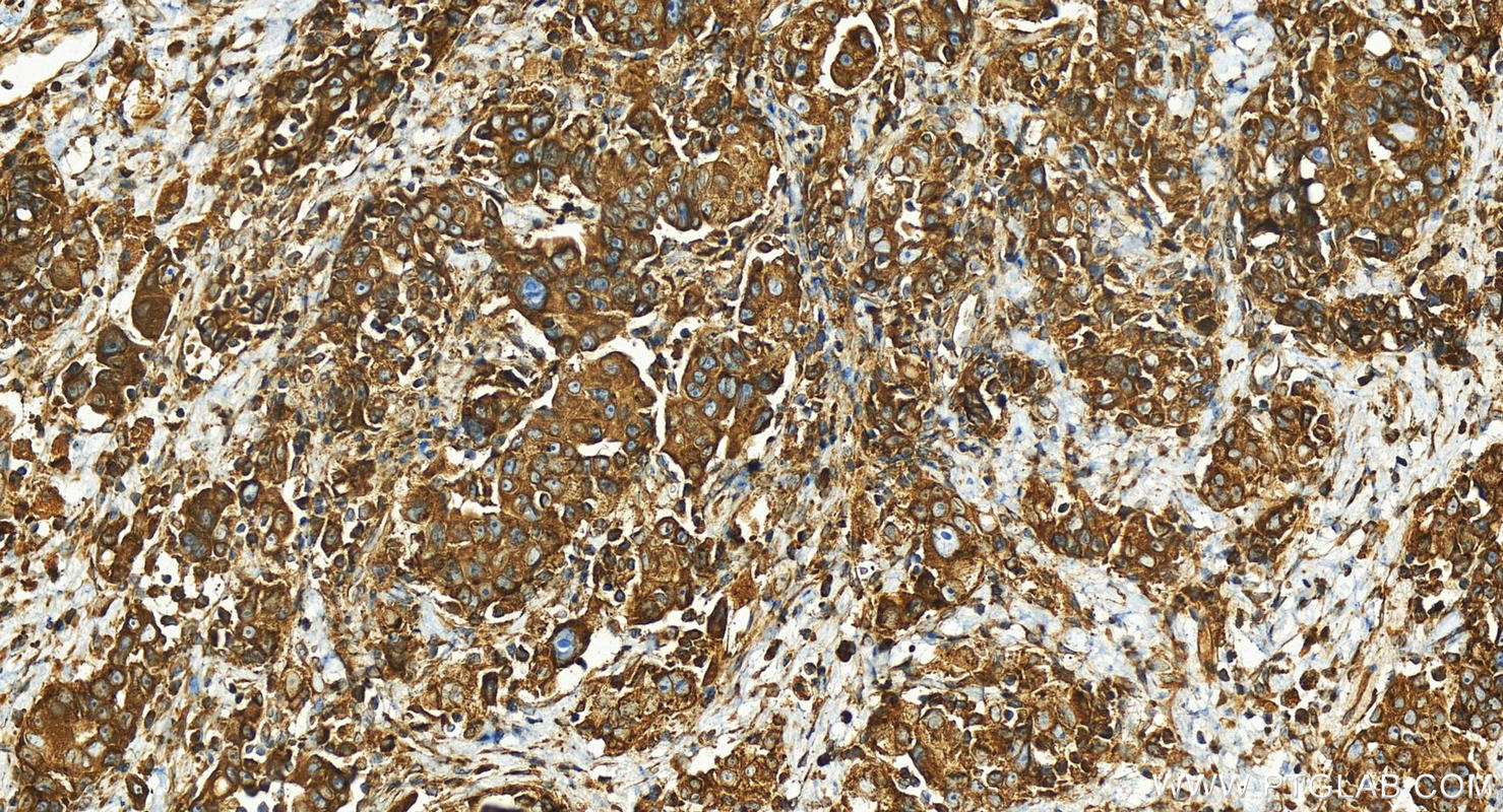 Immunohistochemistry (IHC) staining of human ovary cancer tissue using TMEM111 Polyclonal antibody (24645-1-AP)