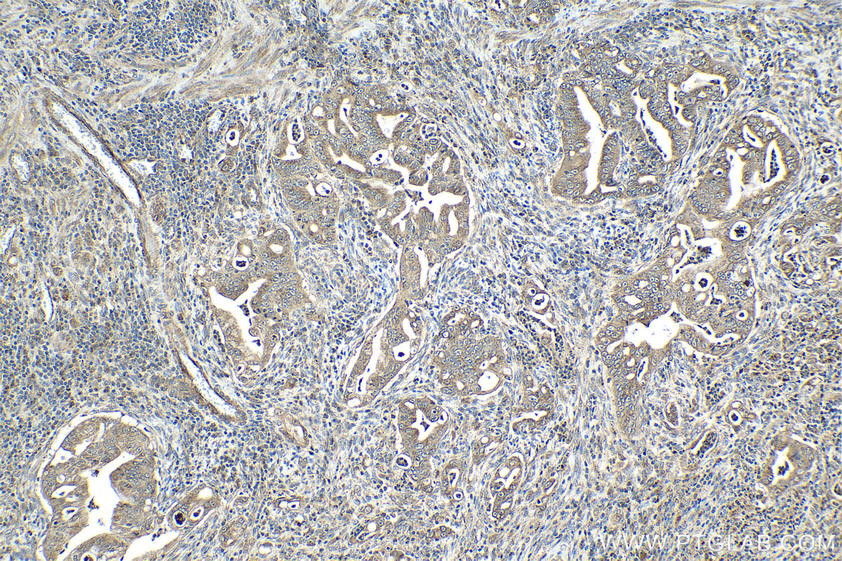 Immunohistochemistry (IHC) staining of human stomach cancer tissue using TMEM127 Polyclonal antibody (23142-1-AP)