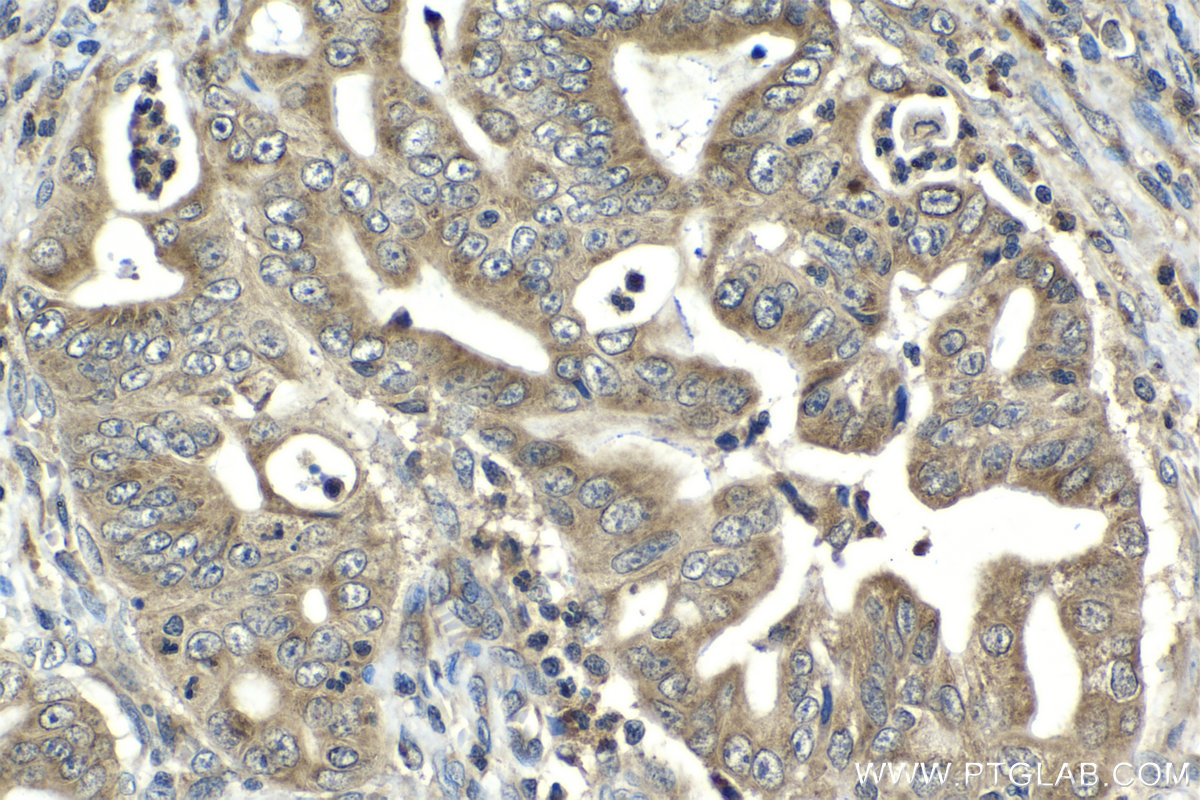 Immunohistochemistry (IHC) staining of human stomach cancer tissue using TMEM127 Polyclonal antibody (23142-1-AP)