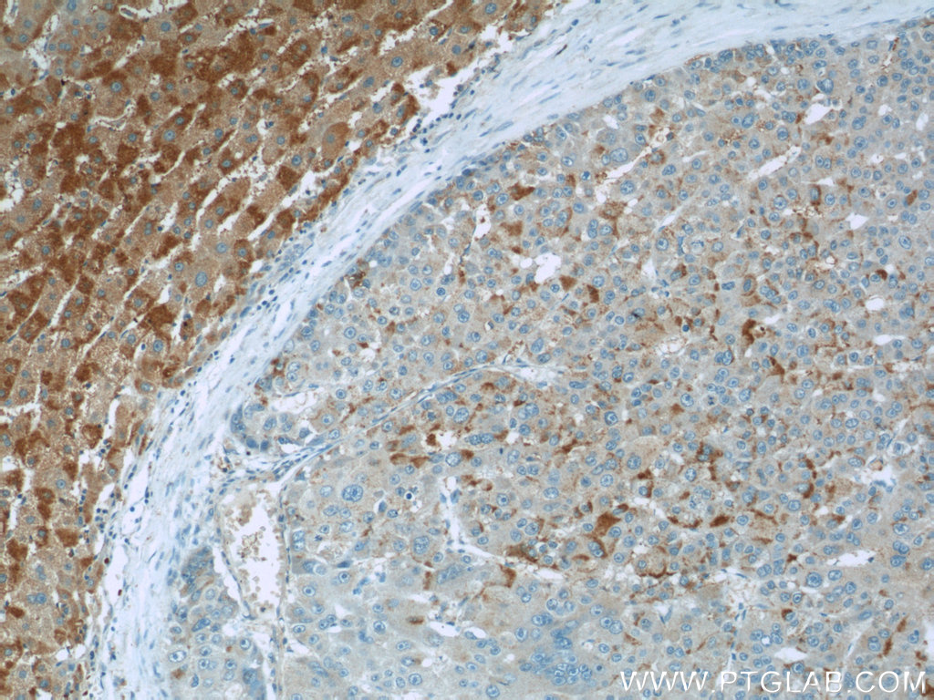 Immunohistochemistry (IHC) staining of human liver cancer tissue using TMEM127 Polyclonal antibody (23142-1-AP)