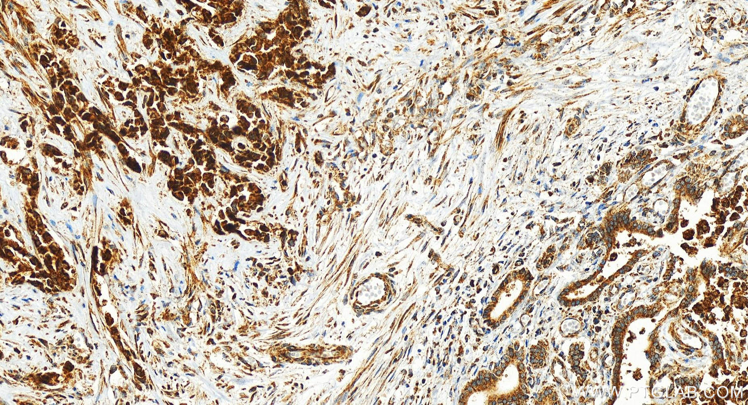 Immunohistochemistry (IHC) staining of human intrahepatic cholangiocarcinoma tissue using TMEM160 Polyclonal antibody (26451-1-AP)