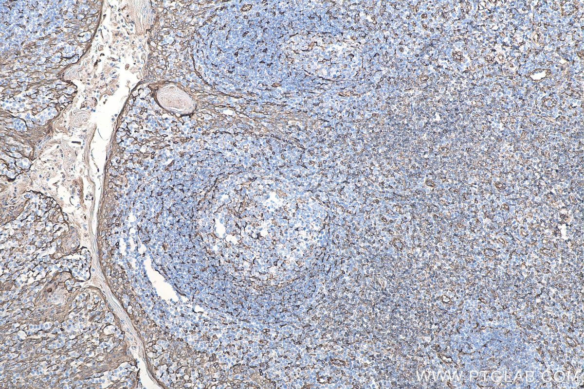Immunohistochemistry (IHC) staining of human tonsillitis tissue using TMEM173/STING Recombinant monoclonal antibody (80165-1-RR)