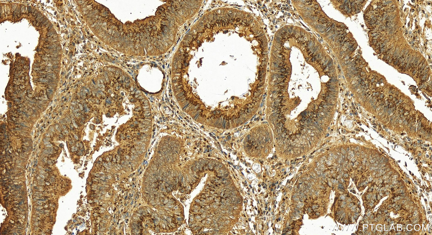 Immunohistochemistry (IHC) staining of human colon cancer tissue using TMF1 Polyclonal antibody (22212-1-AP)