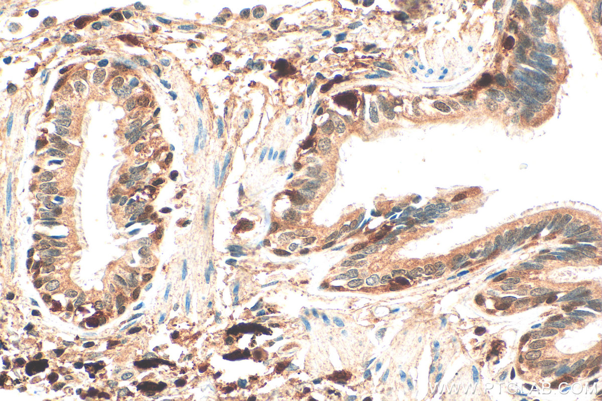 Immunohistochemistry (IHC) staining of human lung cancer tissue using ASC/TMS1 Polyclonal antibody (10500-1-AP)