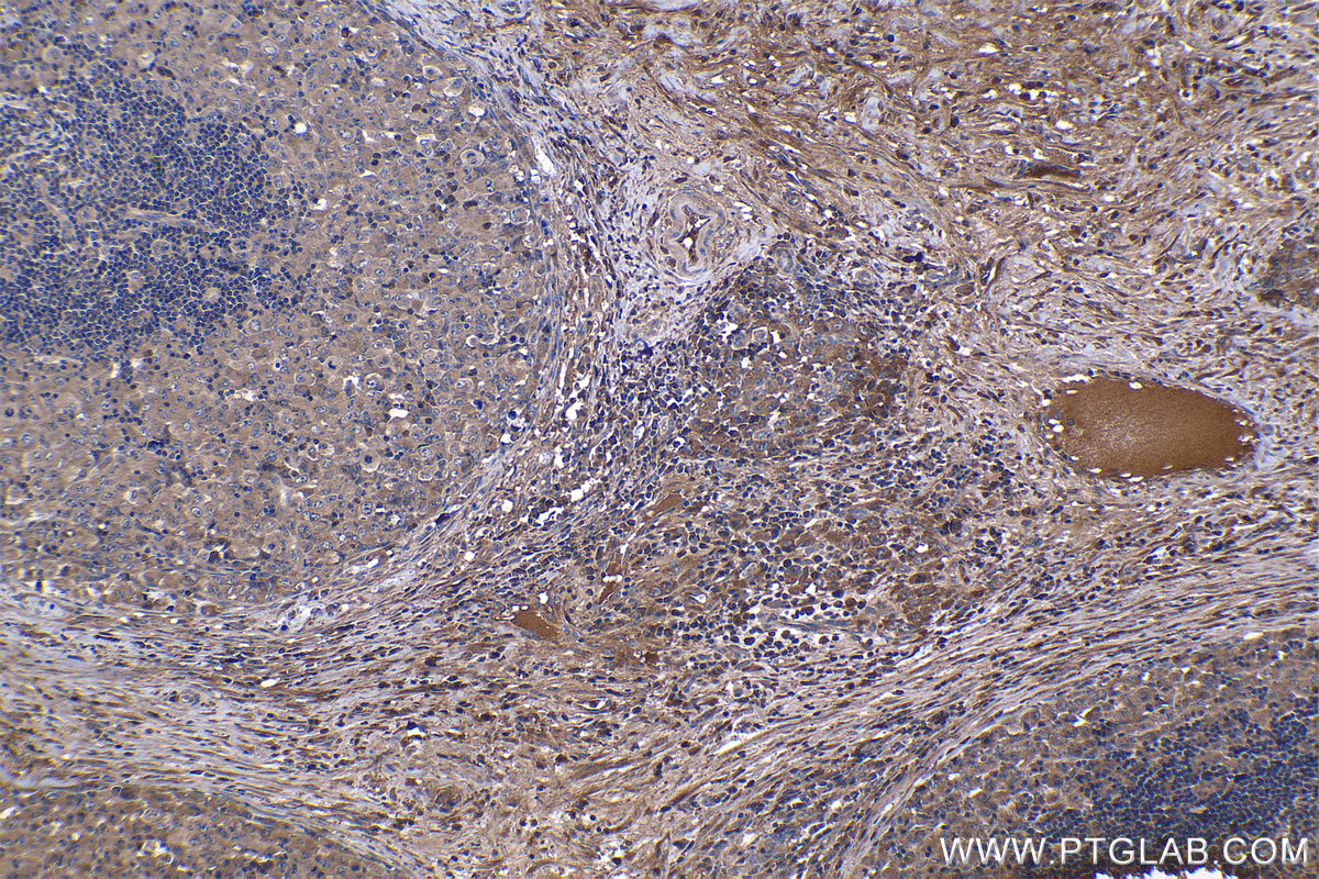 Immunohistochemistry (IHC) staining of human lymphoma tissue using TNF-alpha Monoclonal antibody (60291-1-Ig)