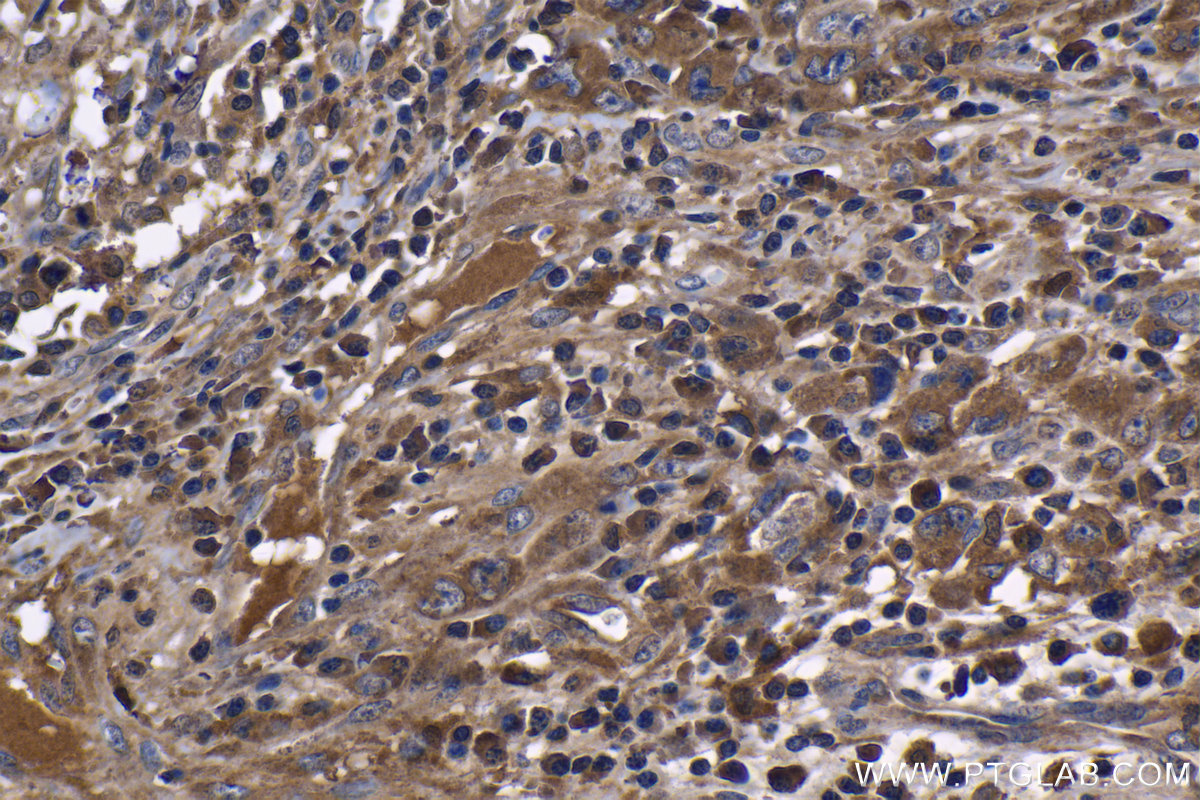 Immunohistochemistry (IHC) staining of human lymphoma tissue using TNF-alpha Monoclonal antibody (60291-1-Ig)