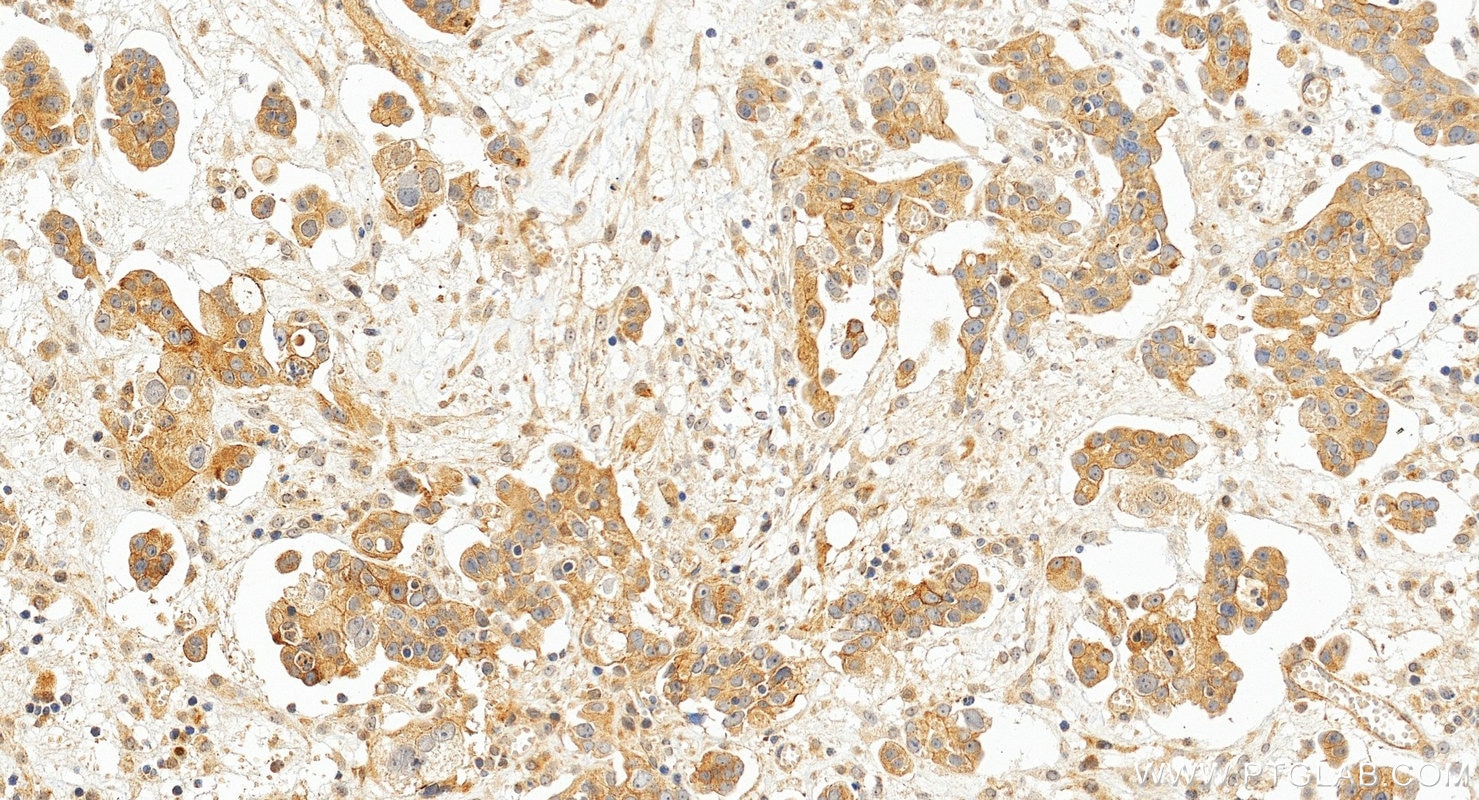Immunohistochemistry (IHC) staining of human ovary cancer tissue using TNF-alpha Polyclonal antibody (17590-1-AP)