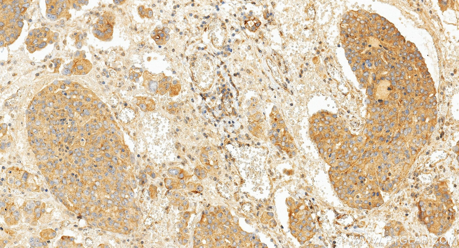 Immunohistochemistry (IHC) staining of human ovary cancer tissue using TNF-alpha Polyclonal antibody (17590-1-AP)