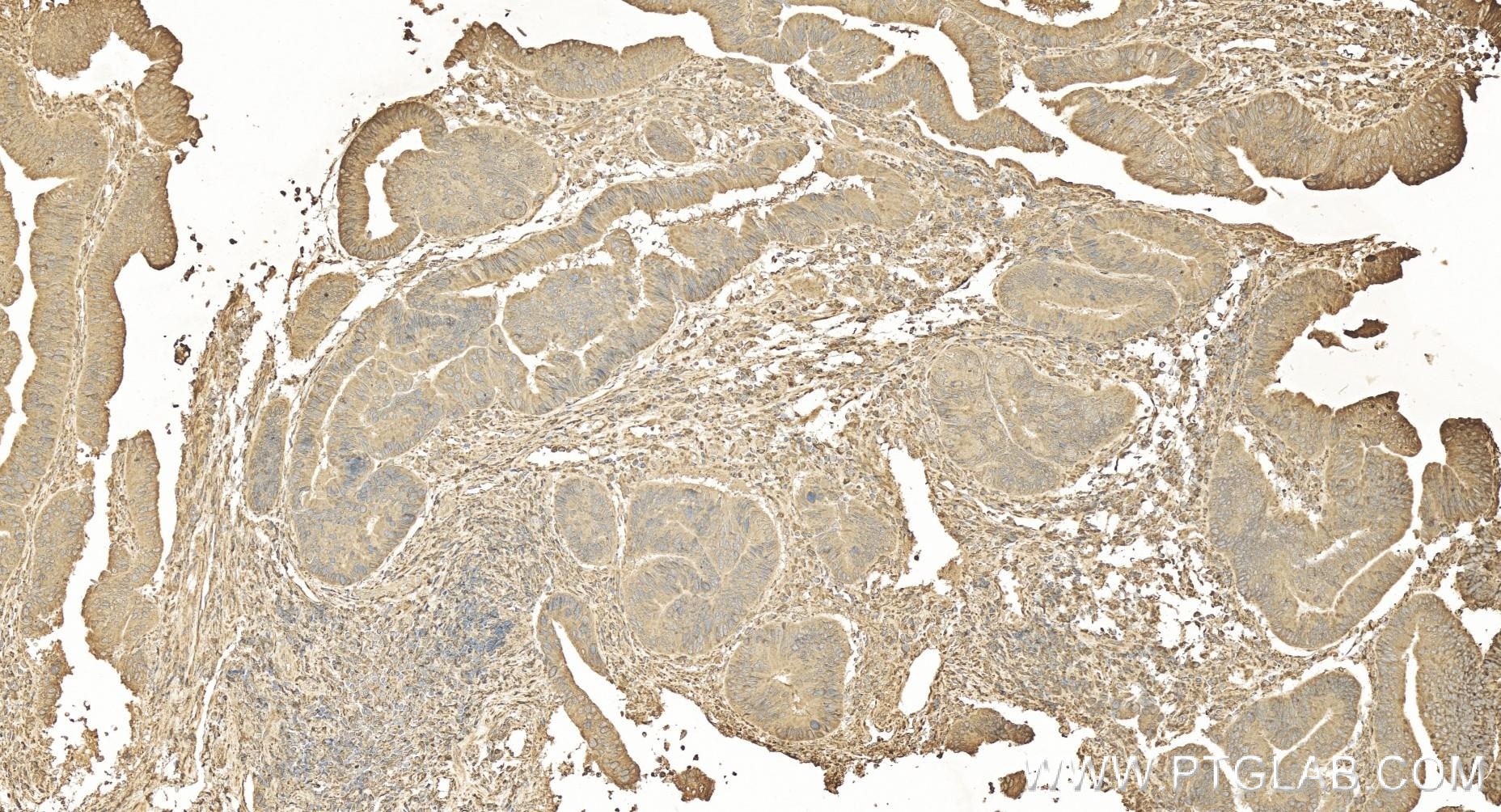 Immunohistochemistry (IHC) staining of human colon cancer tissue using TNFR1/CD120a  Recombinant antibody (84243-5-RR)