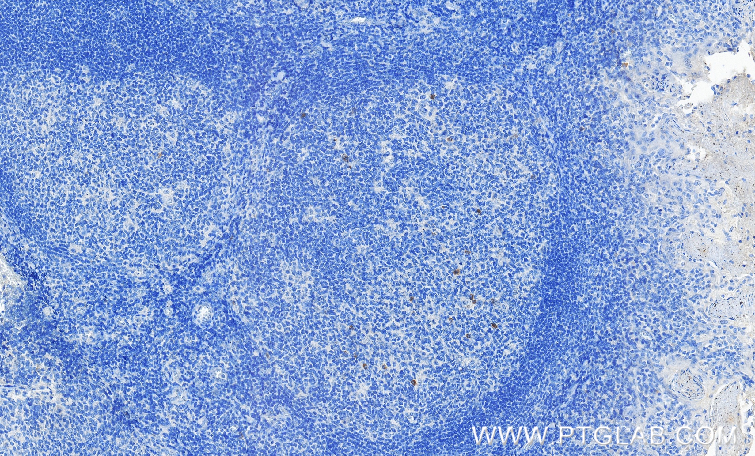 Immunohistochemistry (IHC) staining of human tonsillitis tissue using Anti-Human TNFRSF9/CD137 Rabbit Recombinant Antibo (98112-1-RR)