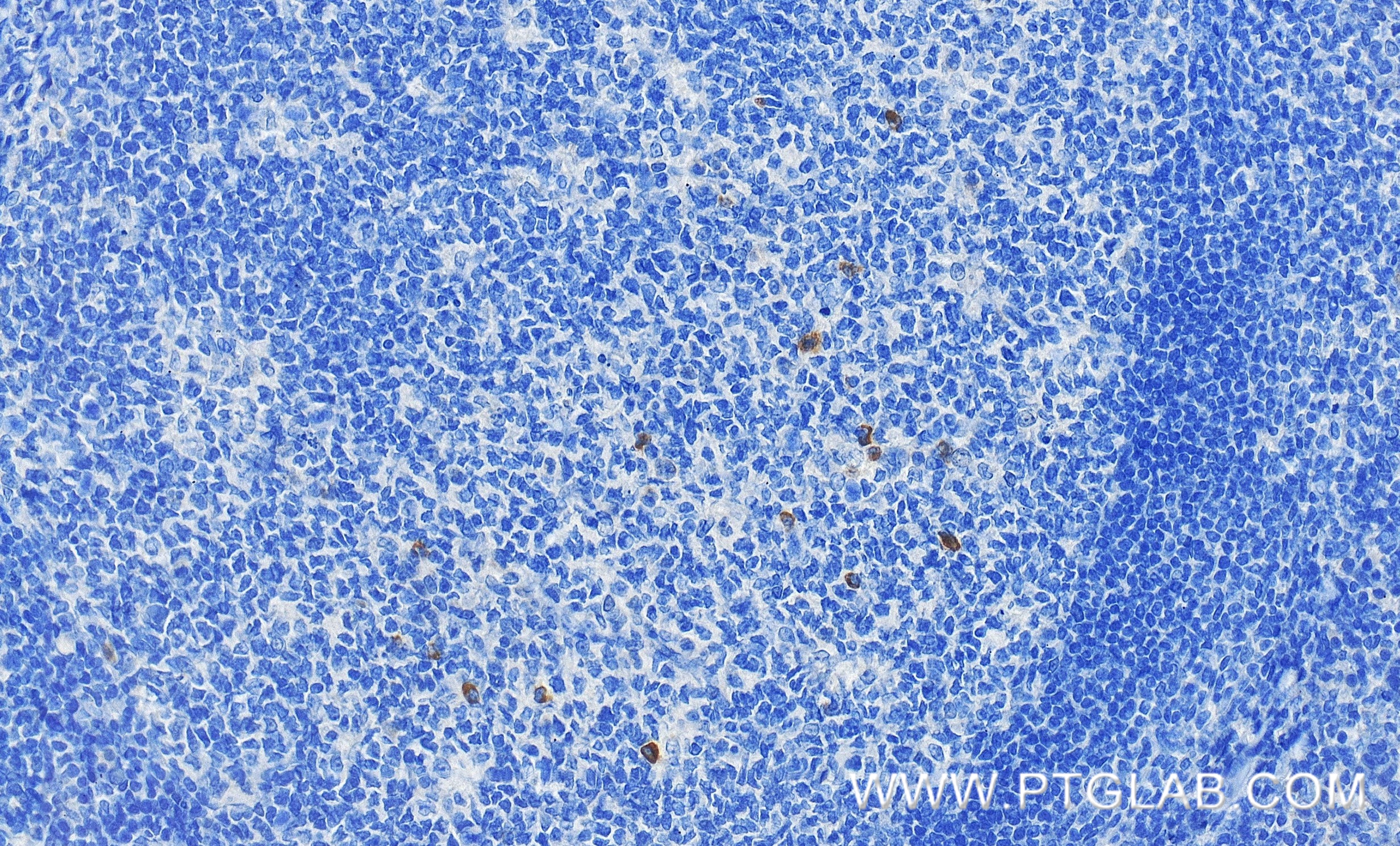 Immunohistochemistry (IHC) staining of human tonsillitis tissue using Anti-Human TNFRSF9/CD137 Rabbit Recombinant Antibo (98112-1-RR)