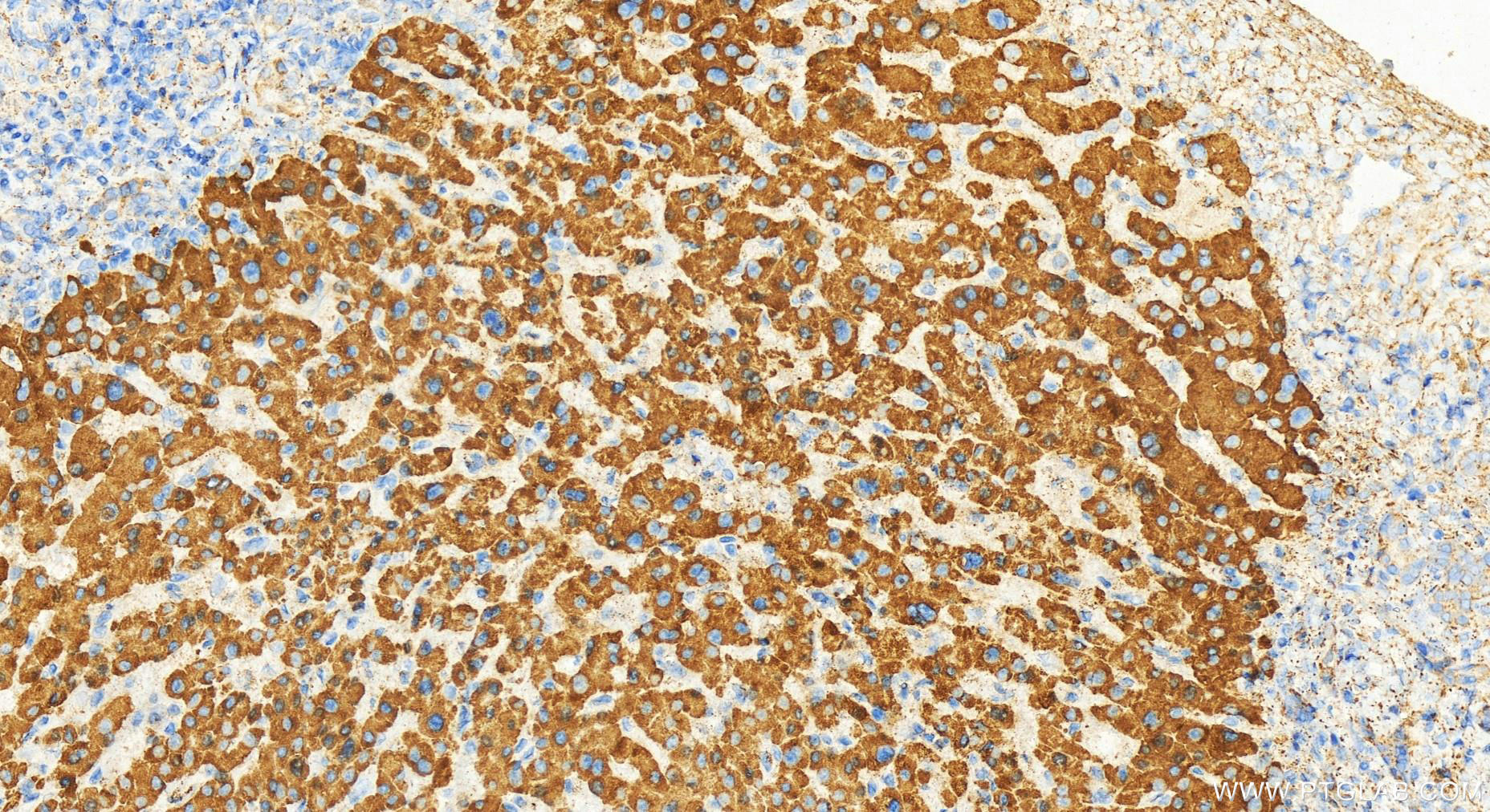 Immunohistochemistry (IHC) staining of human intrahepatic cholangiocarcinoma tissue using TNFSF13B/BAFF Polyclonal antibody (11862-1-AP)