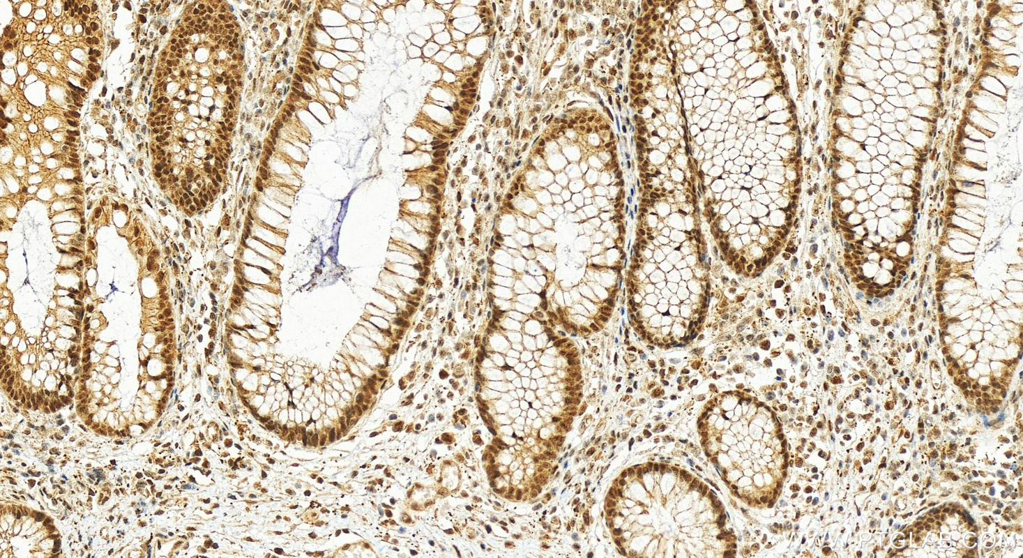 Immunohistochemistry (IHC) staining of human colon cancer tissue using TOE1 Polyclonal antibody (16203-1-AP)