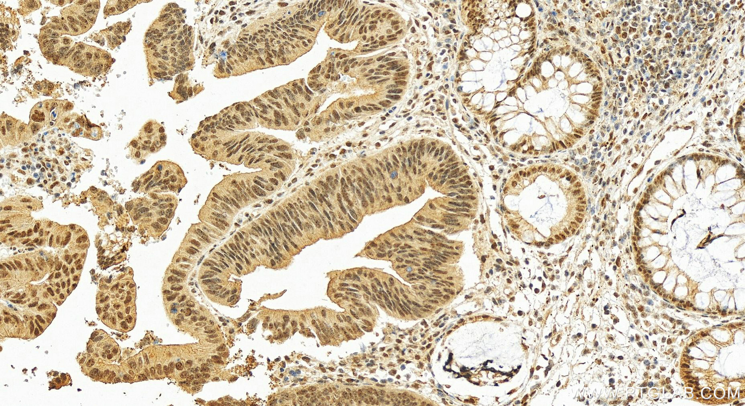 Immunohistochemistry (IHC) staining of human colon cancer tissue using TOE1 Polyclonal antibody (16203-1-AP)