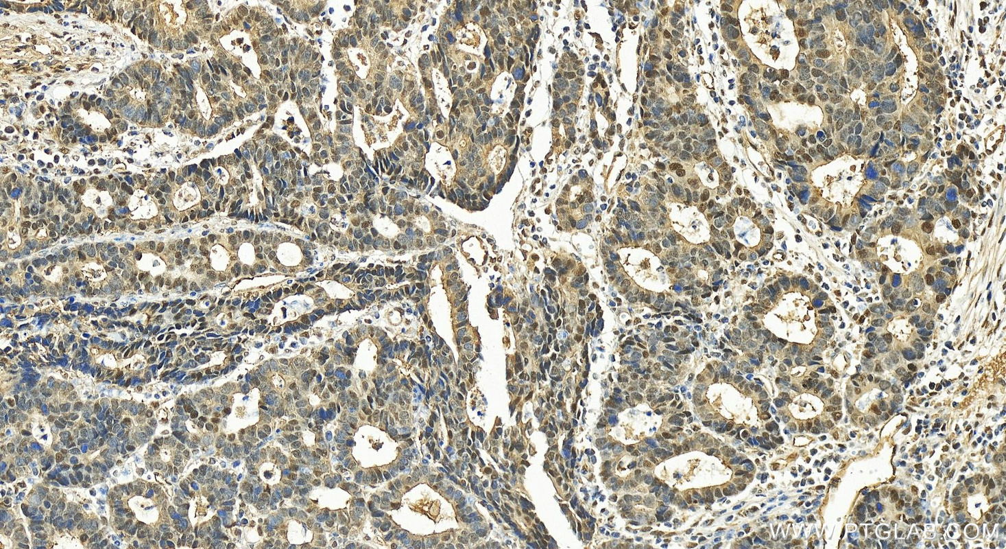 Immunohistochemistry (IHC) staining of human stomach cancer tissue using TOE1 Polyclonal antibody (30221-1-AP)