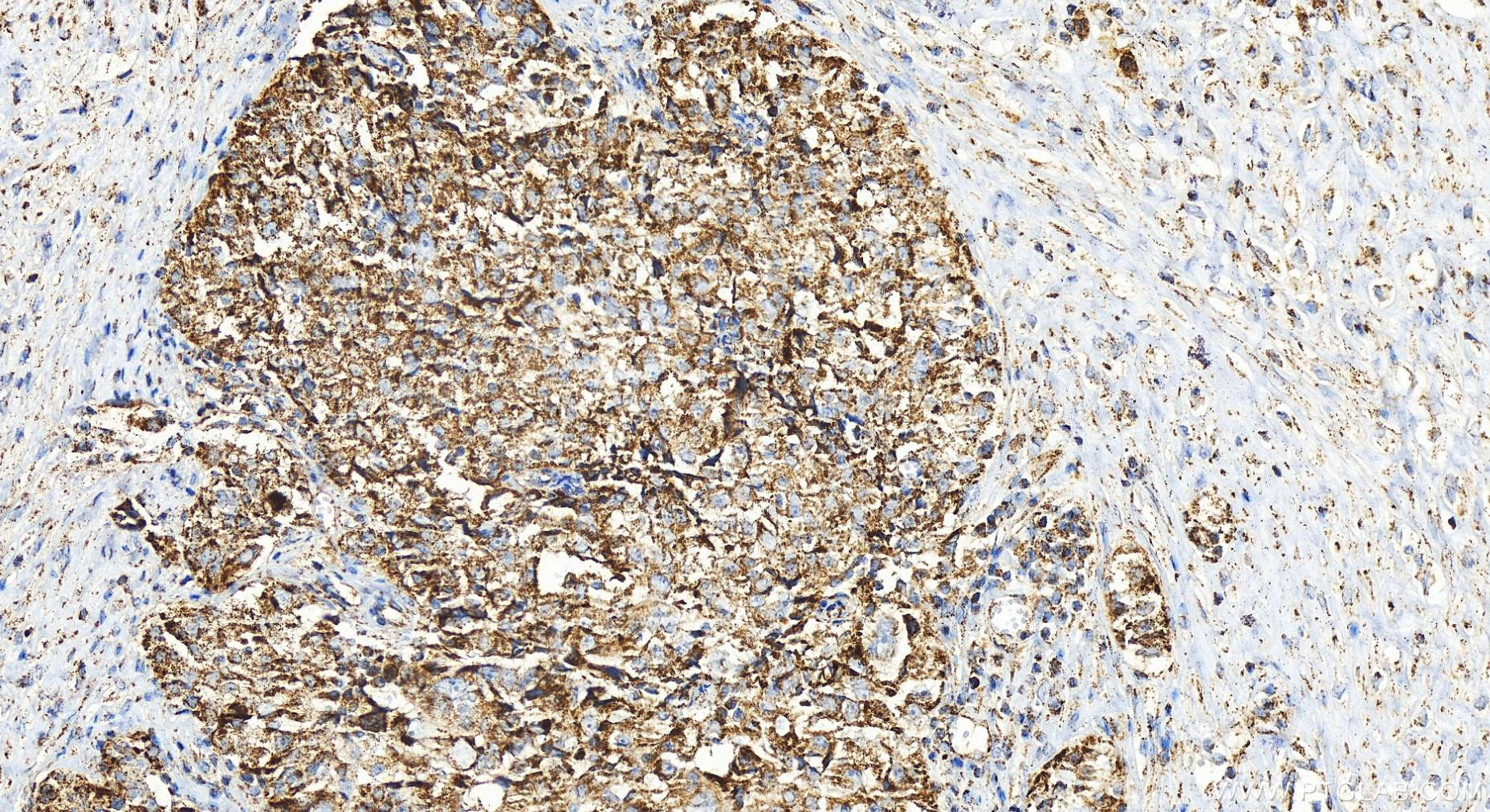 Immunohistochemistry (IHC) staining of human ovary cancer tissue using TOMM5 Polyclonal antibody (25607-1-AP)