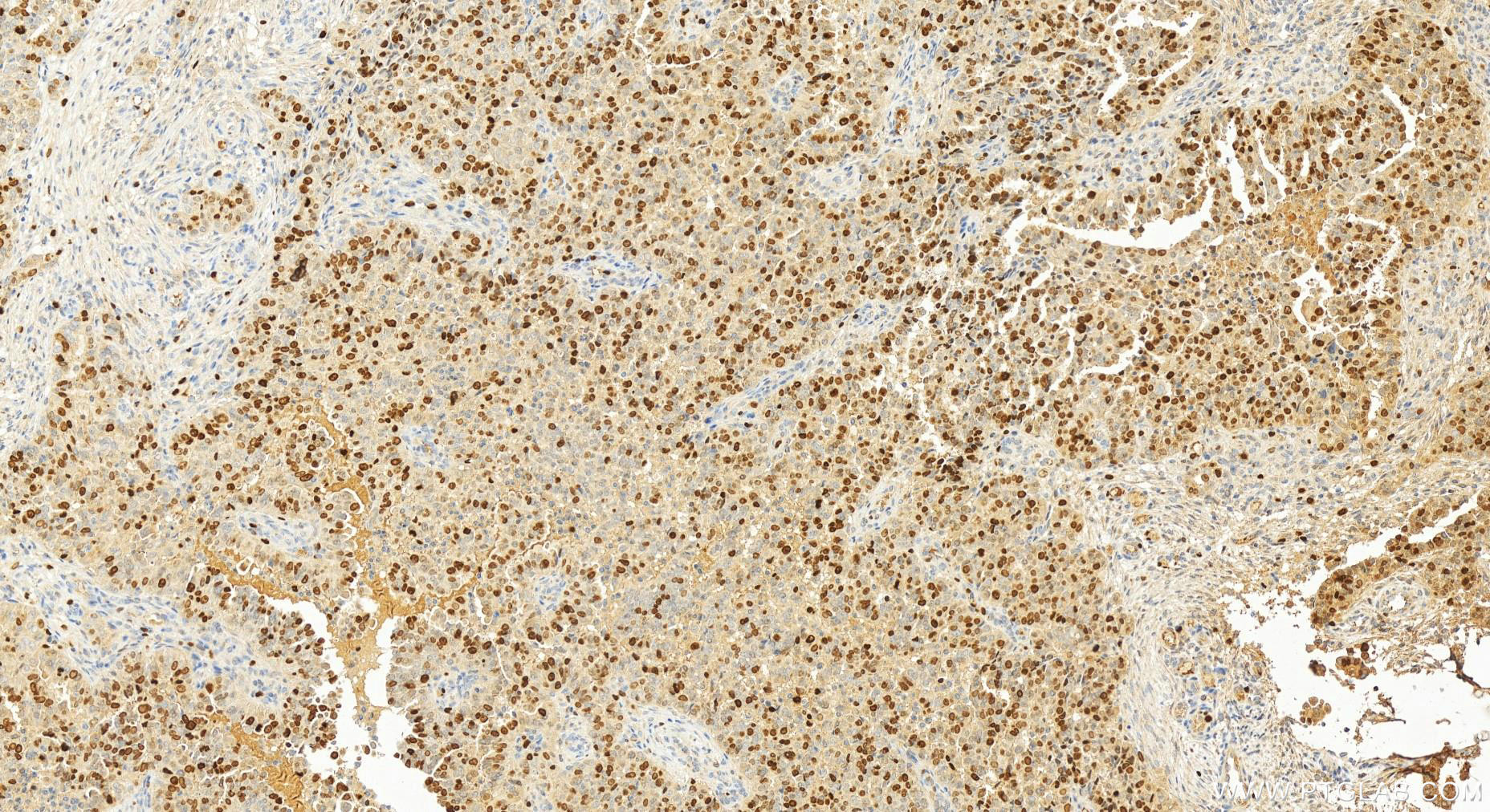 Immunohistochemistry (IHC) staining of human ovary cancer tissue using TOP2A-Specific Polyclonal antibody (20233-1-AP)