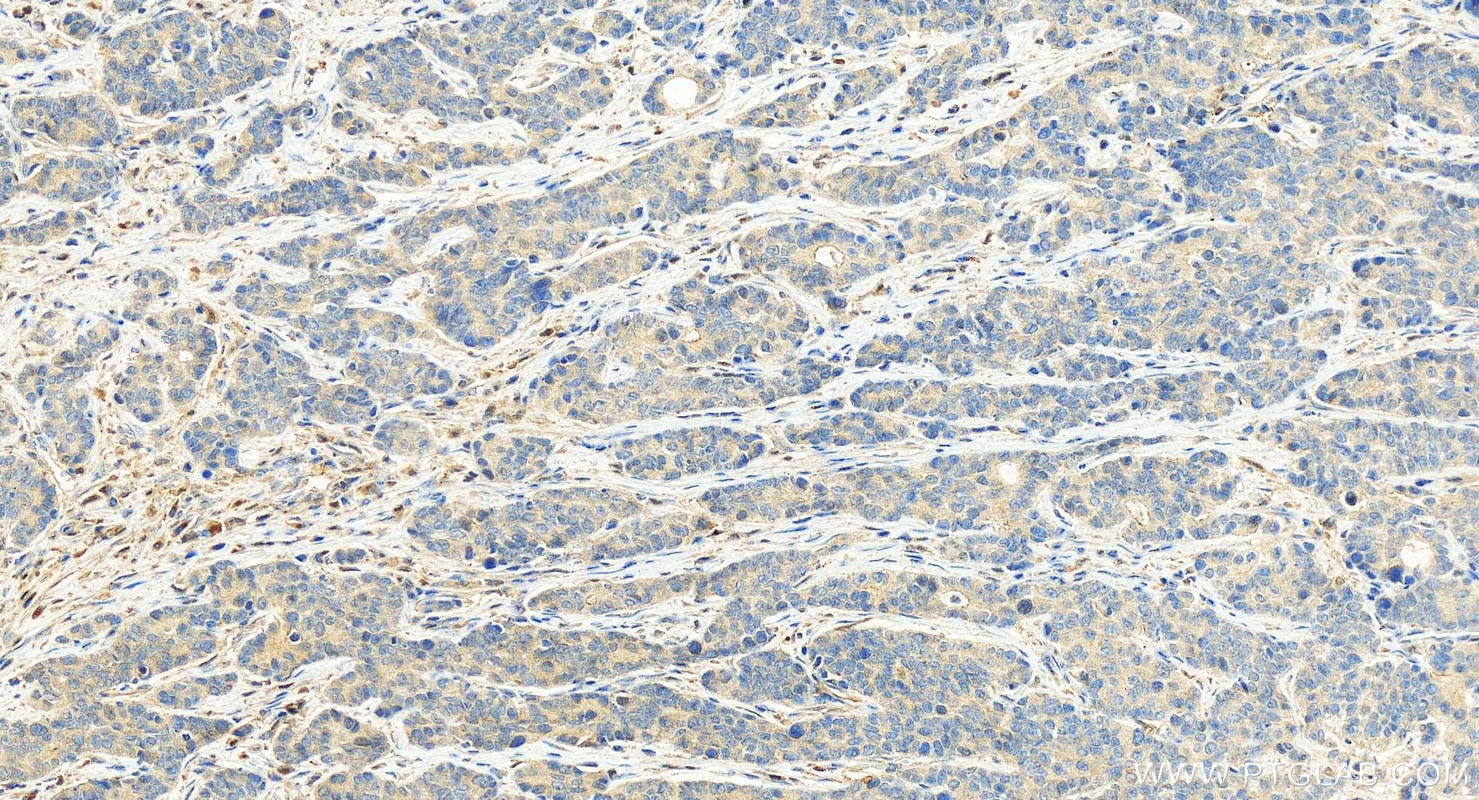 Immunohistochemistry (IHC) staining of human stomach cancer tissue using TOR2A Polyclonal antibody (19511-1-AP)