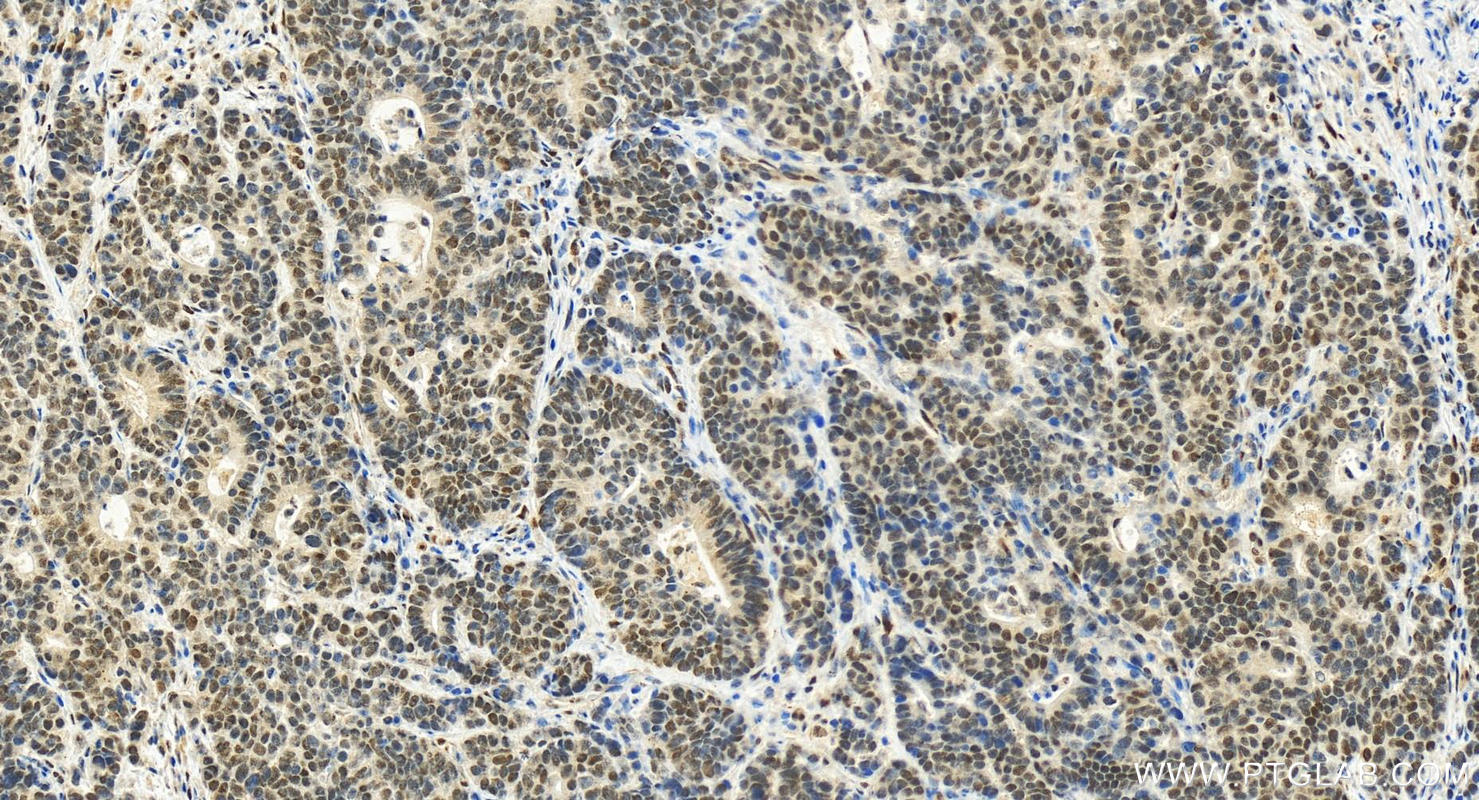 Immunohistochemistry (IHC) staining of human stomach cancer tissue using TP53BP1-Specific Polyclonal antibody (20002-1-AP)