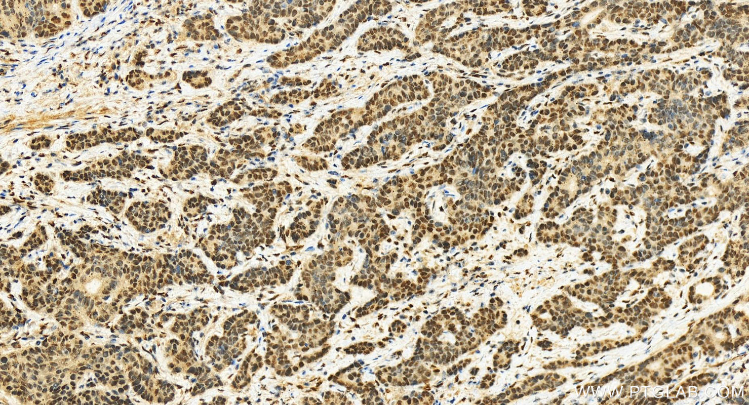 Immunohistochemistry (IHC) staining of human stomach cancer tissue using TP53BP1-Specific Polyclonal antibody (20002-1-AP)