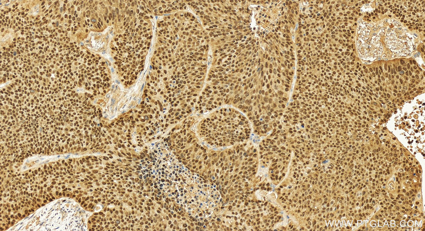 Immunohistochemistry (IHC) staining of human lung squamous cell carcinoma tissue using p63 Polyclonal antibody (12143-1-AP)