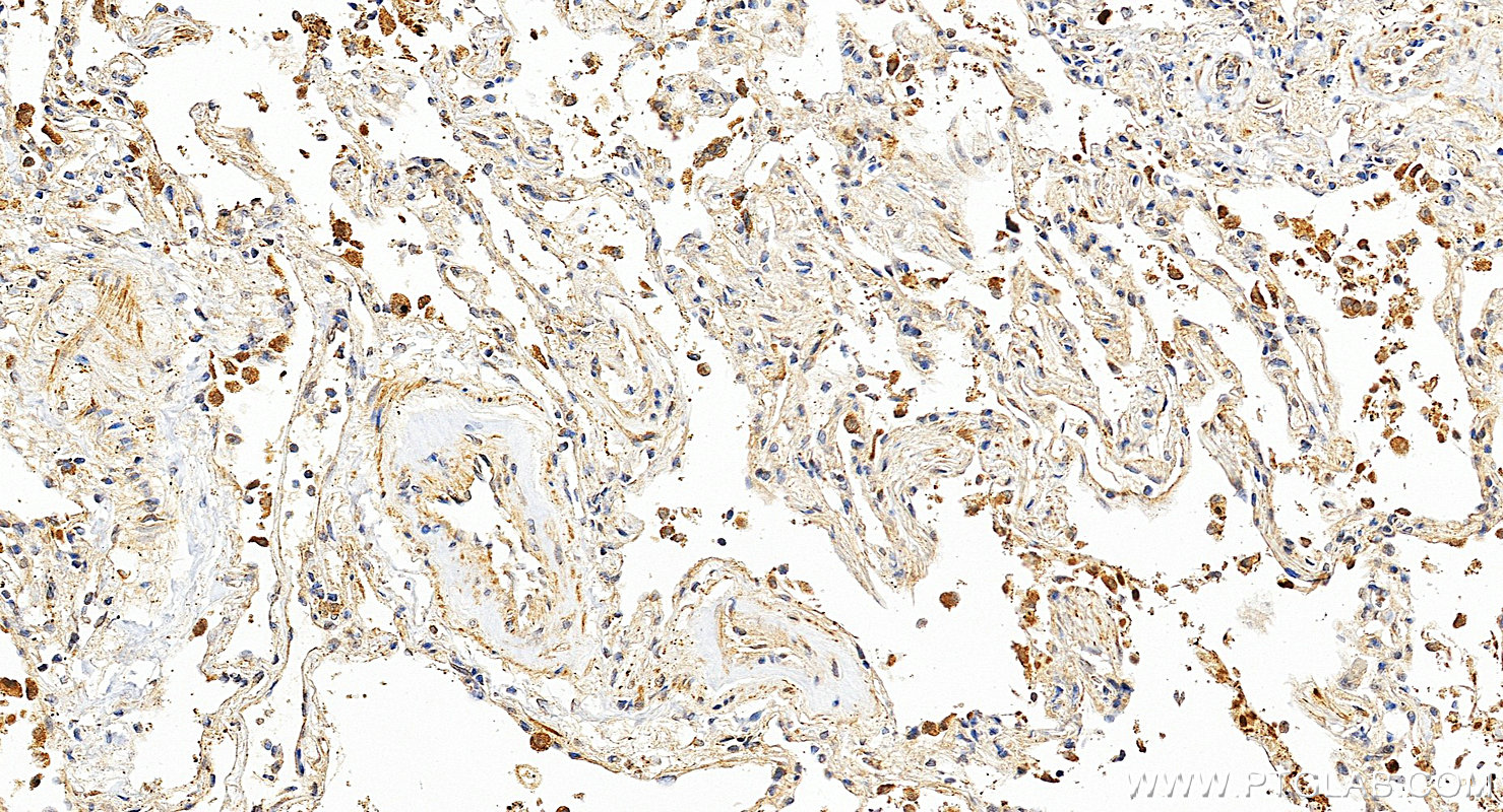 Immunohistochemistry (IHC) staining of human lung cancer tissue using p63 Polyclonal antibody (12143-1-AP)