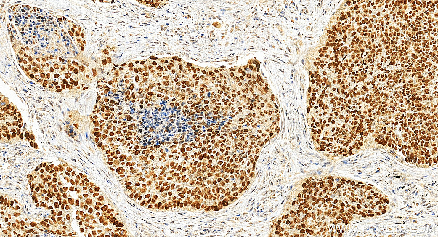 Immunohistochemistry (IHC) staining of human lung cancer tissue using p63 Polyclonal antibody (12143-1-AP)