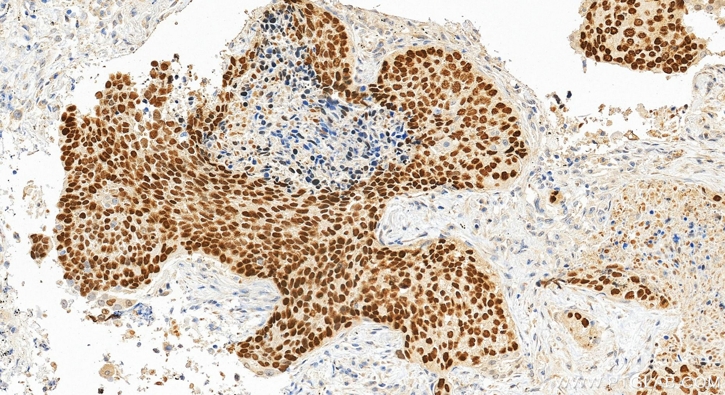 Immunohistochemistry (IHC) staining of human lung cancer tissue using p63 Polyclonal antibody (12143-1-AP)