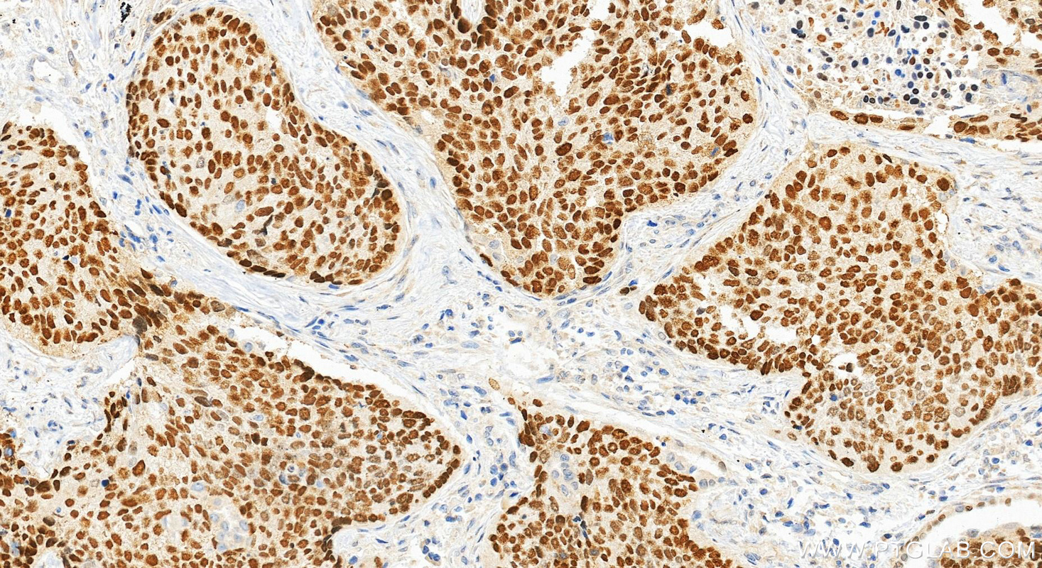 Immunohistochemistry (IHC) staining of human lung cancer tissue using p63 Polyclonal antibody (12143-1-AP)