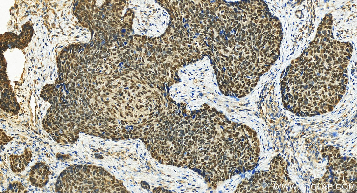 Immunohistochemistry (IHC) staining of human bowen disease using p63 Polyclonal antibody (12143-1-AP)