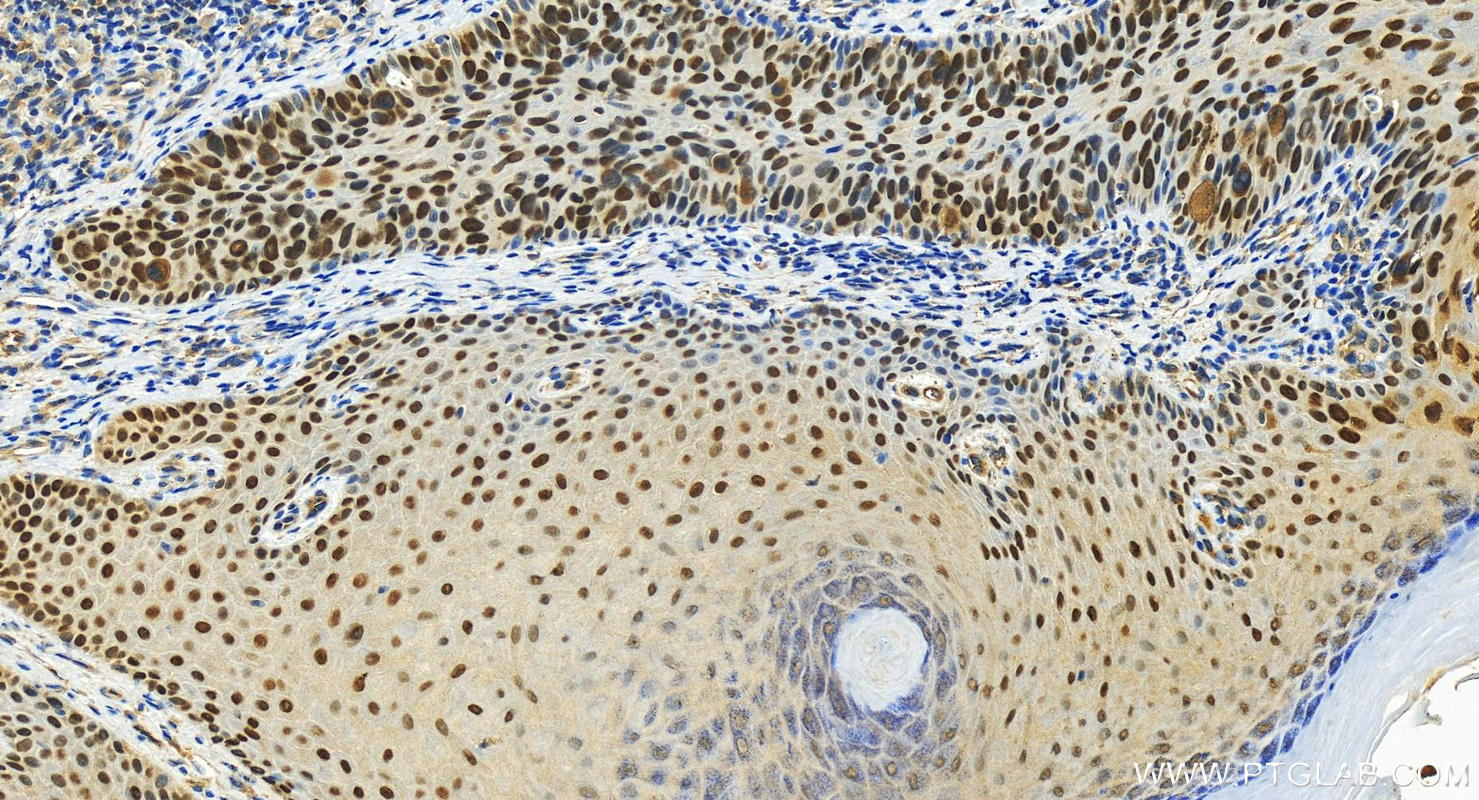 Immunohistochemistry (IHC) staining of human bowen disease using p63 Polyclonal antibody (12143-1-AP)