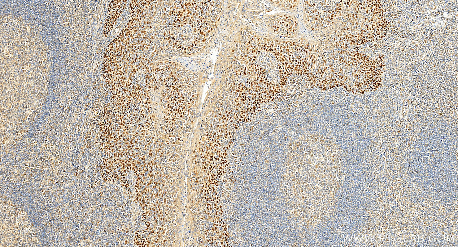 Immunohistochemistry (IHC) staining of human tonsillitis tissue using p63 Polyclonal antibody (12143-1-AP)