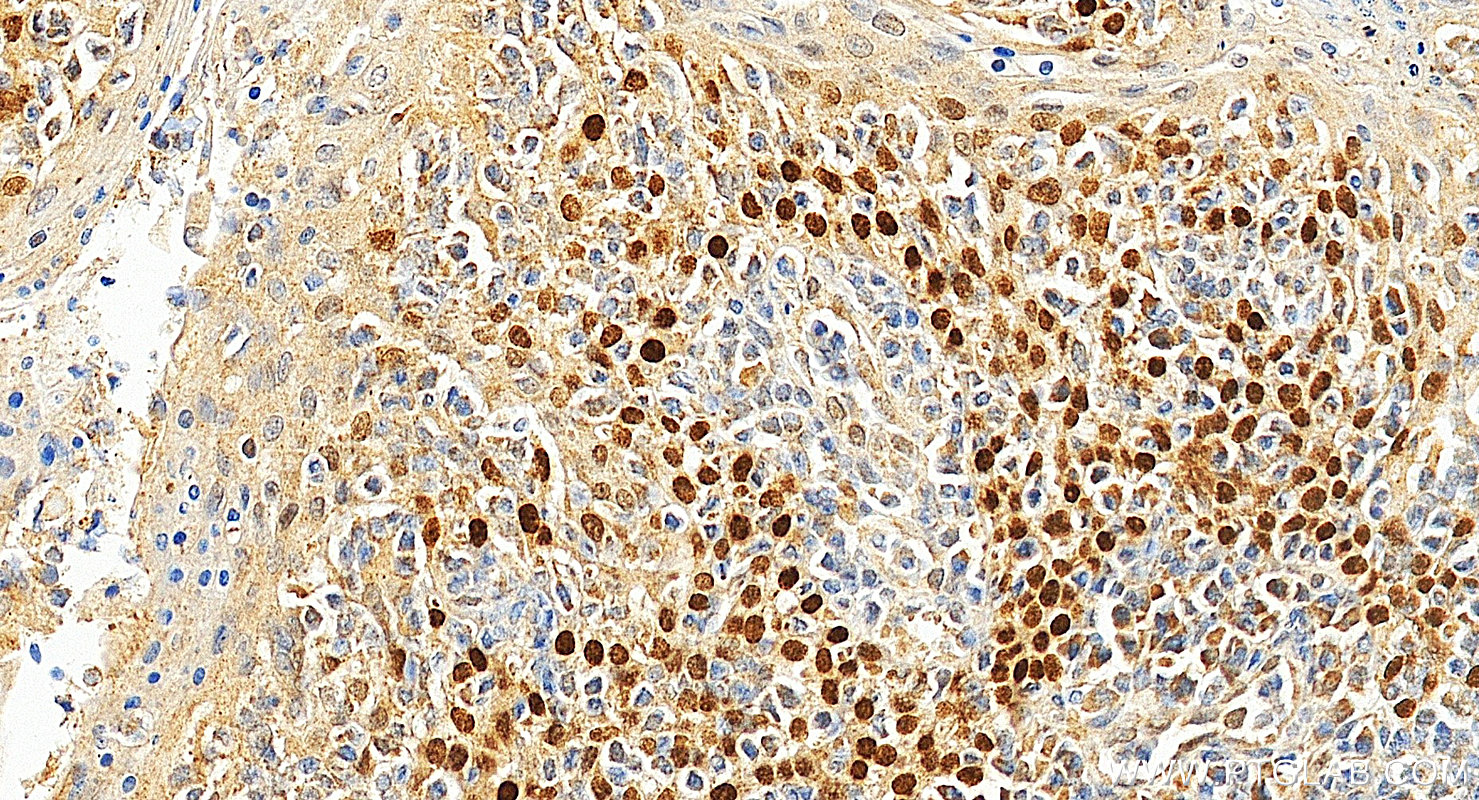 Immunohistochemistry (IHC) staining of human tonsillitis tissue using p63 Polyclonal antibody (12143-1-AP)