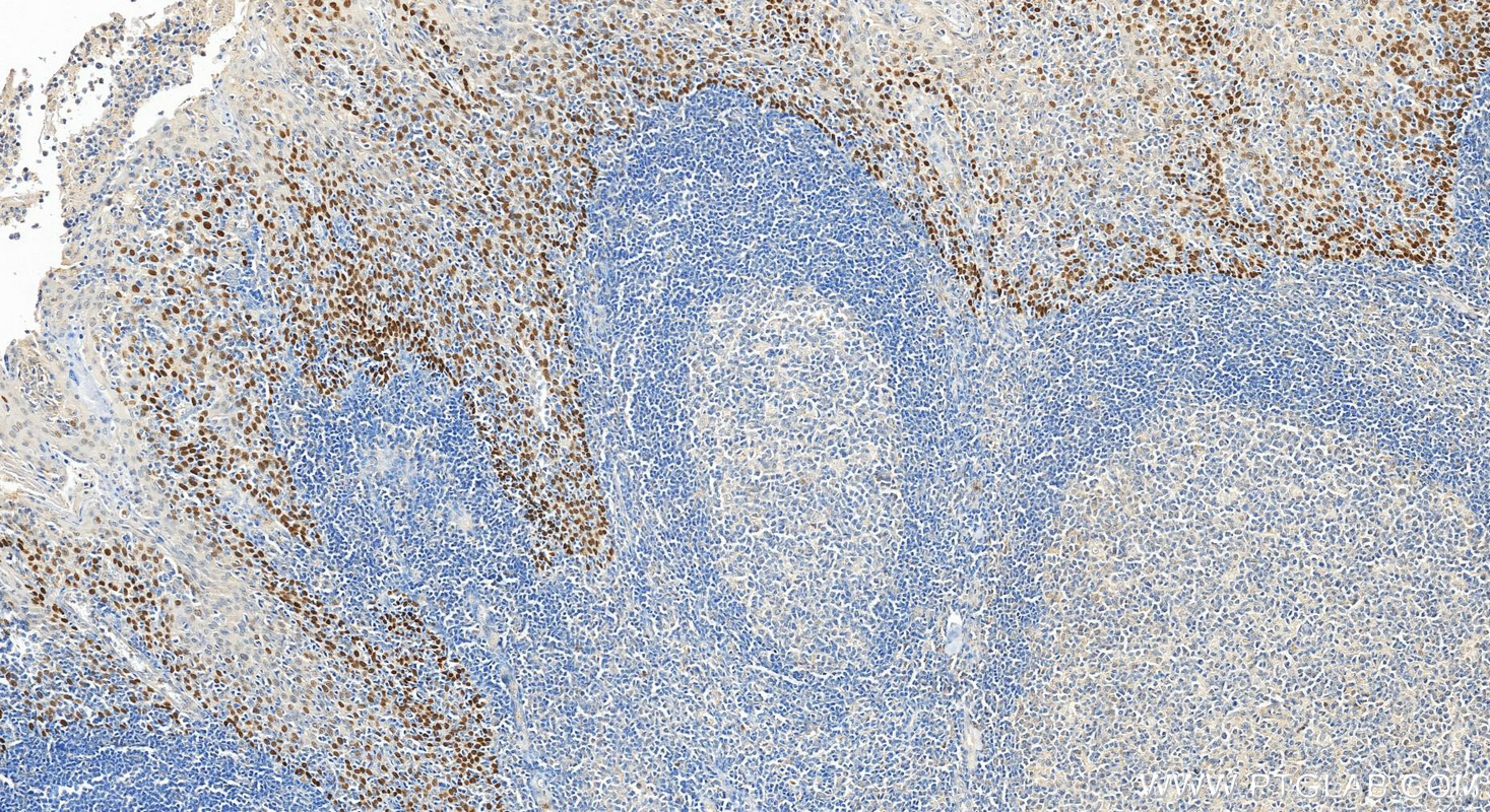 Immunohistochemistry (IHC) staining of human tonsillitis tissue using p63 Polyclonal antibody (12143-1-AP)