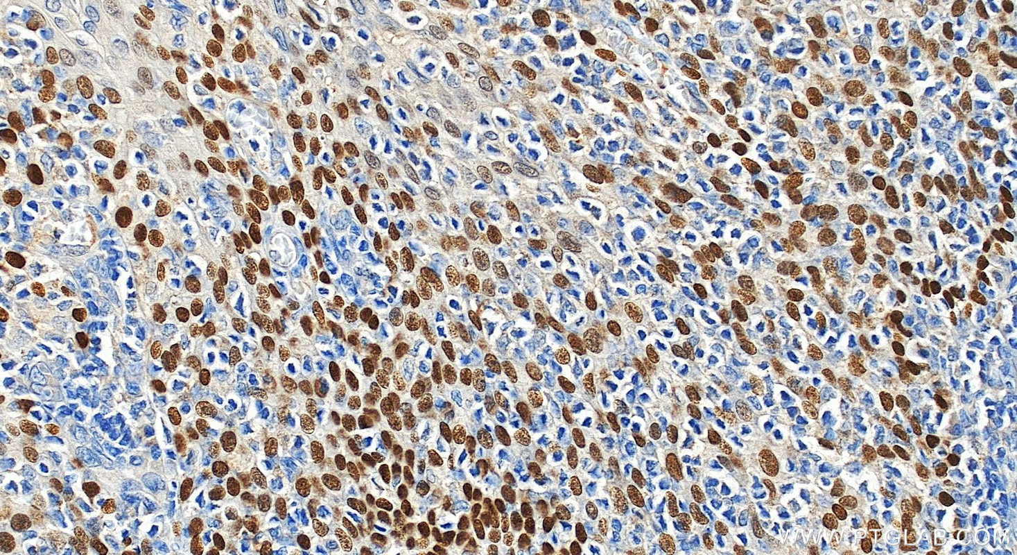 Immunohistochemistry (IHC) staining of human tonsillitis tissue using p63 Polyclonal antibody (12143-1-AP)
