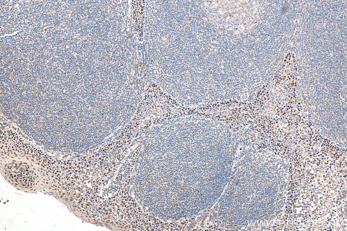 Immunohistochemistry (IHC) staining of human tonsillitis tissue using TP63 Monoclonal antibody (60332-2-Ig)