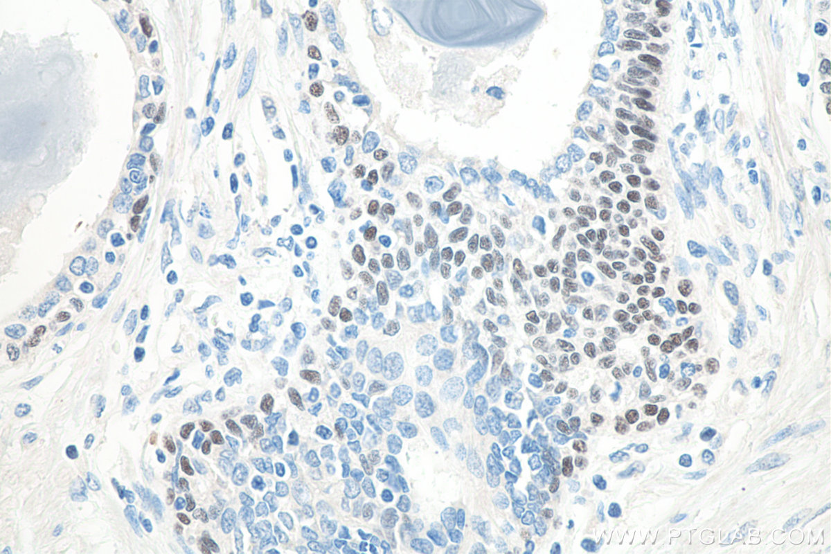 Immunohistochemistry (IHC) staining of human prostate cancer tissue using TP63 Monoclonal antibody (60332-2-Ig)