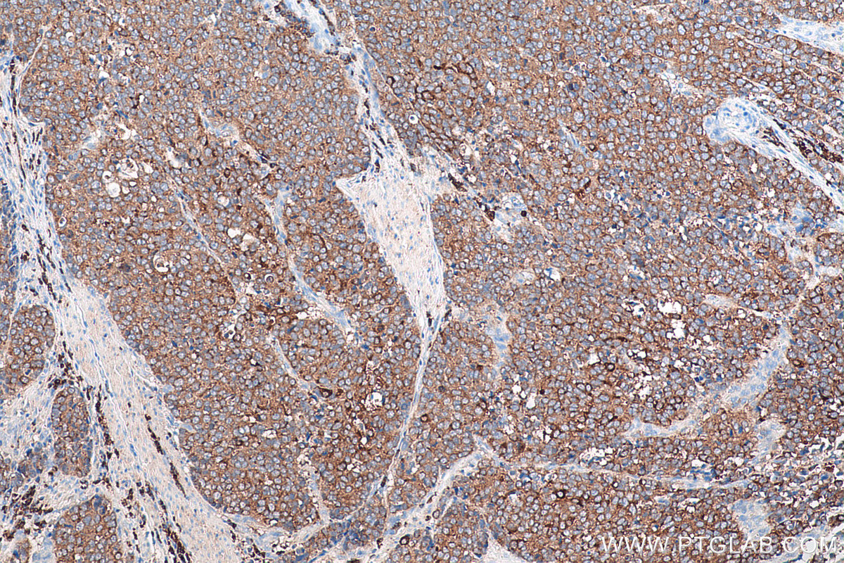 Immunohistochemistry (IHC) staining of human stomach cancer tissue using TPD52 Polyclonal antibody (27648-1-AP)