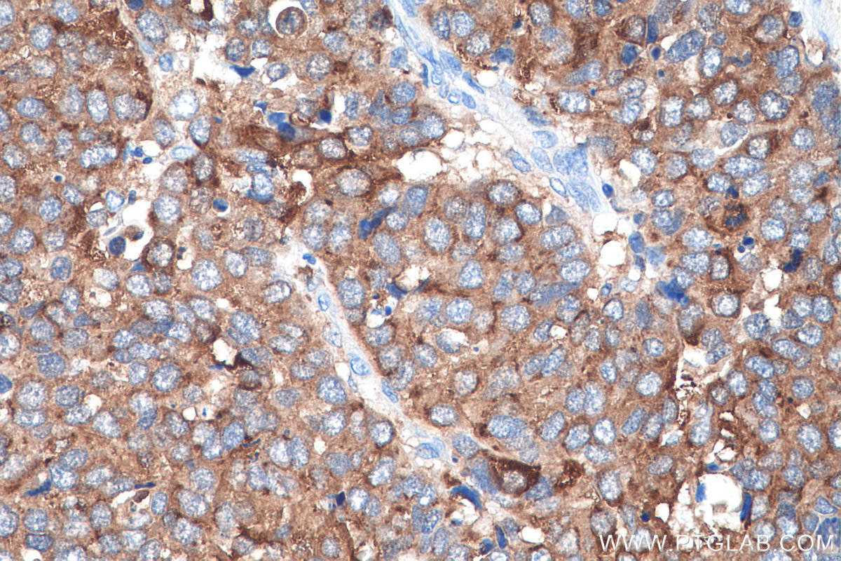 Immunohistochemistry (IHC) staining of human stomach cancer tissue using TPD52 Polyclonal antibody (27648-1-AP)