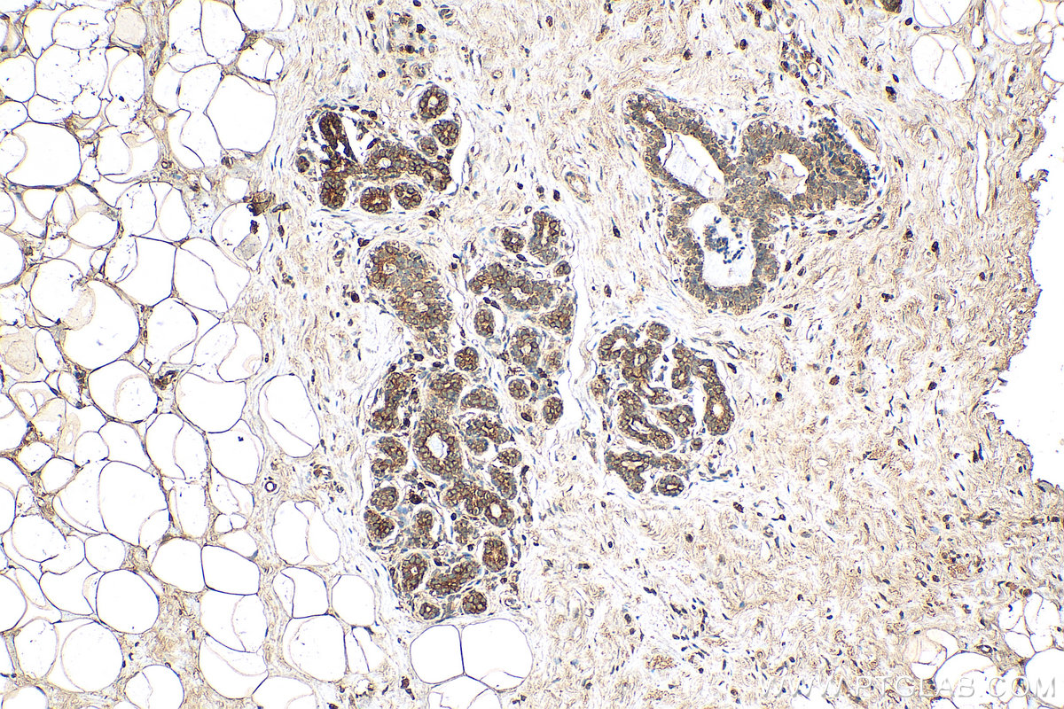 Immunohistochemistry (IHC) staining of human breast cancer tissue using TPD52L2 Monoclonal antibody (68077-1-Ig)