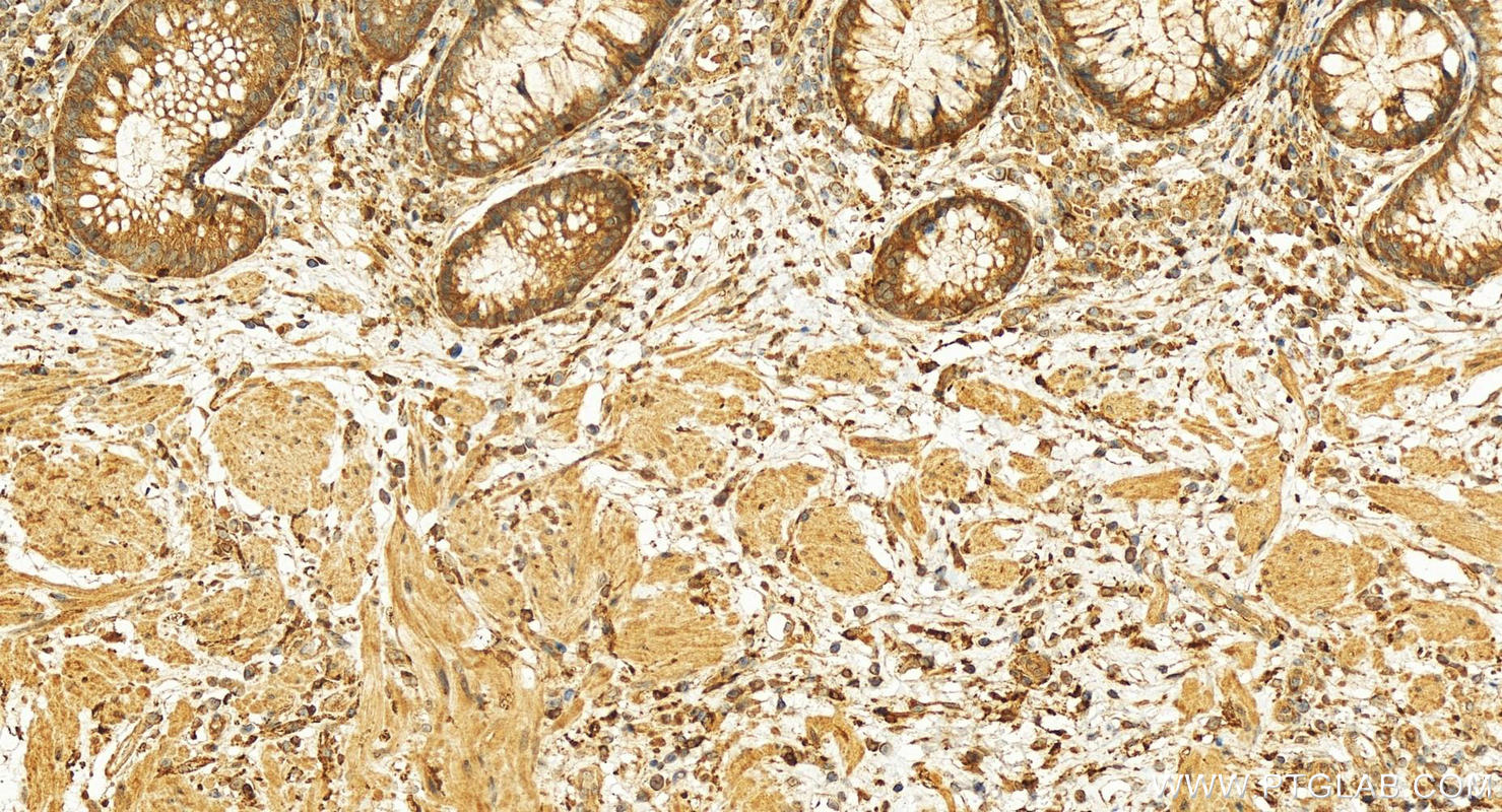 Immunohistochemistry (IHC) staining of human colon cancer tissue using TPK1 Polyclonal antibody (10942-1-AP)