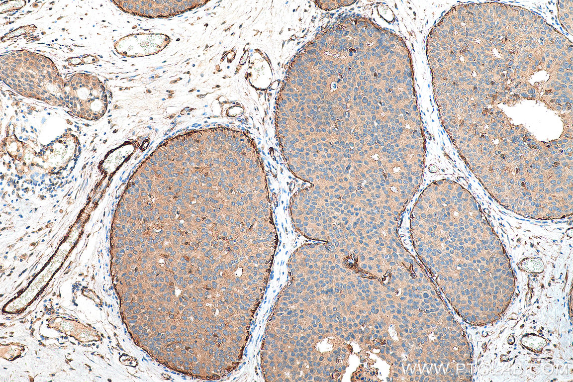 Immunohistochemistry (IHC) staining of human breast cancer tissue using TPM2 Polyclonal antibody (11038-1-AP)